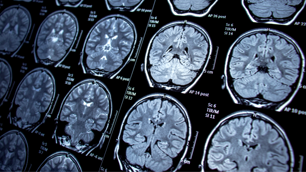 Image of pictures of the brain captured by MRI