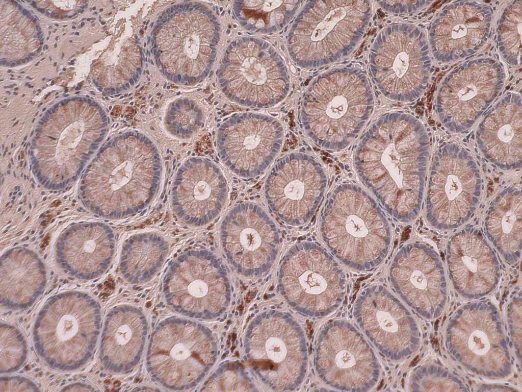 Microscopic image of toxic protein clumps